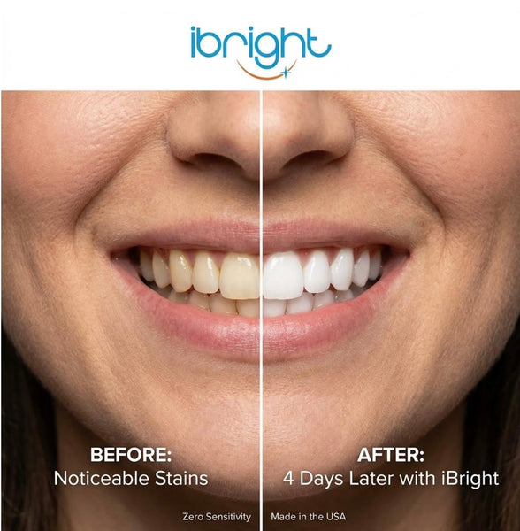 ibright Smartphone Teeth Whitening System